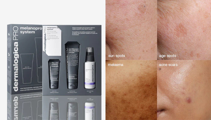 how to deal with hyperpigmentation & darkened spots